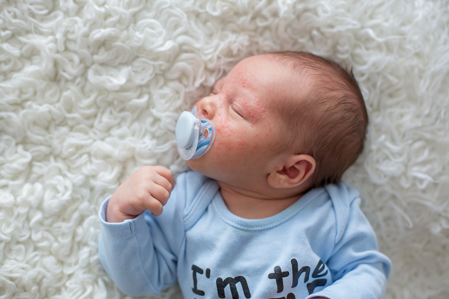 zak rukken milieu Baby acne: wat is het en wat kan je eraan doen? – 24Baby.nl